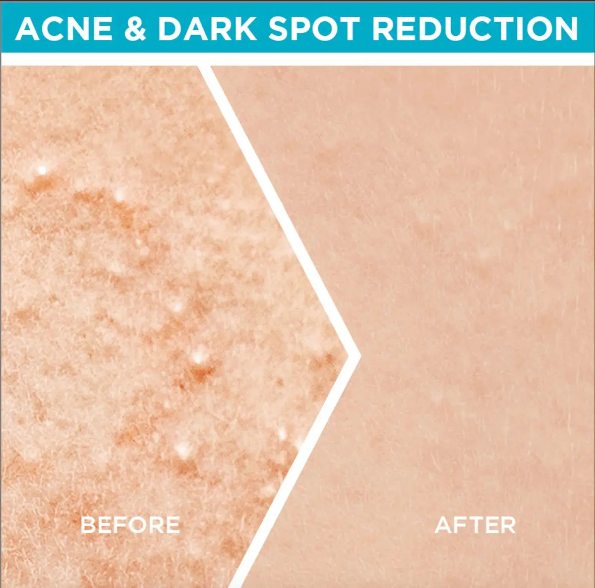 Garnier Fast Clear Serum for Acne-Prone Skin (15 ml) - LAB BEAUTY